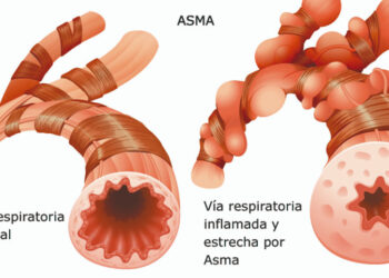 VARON Refuerza la Salud Pulmonar en México Durante el Mes del Asma