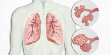 Innovador medicamento para Fibrosis Pulmonar podría extender la supervivencia hasta más de 5 años
