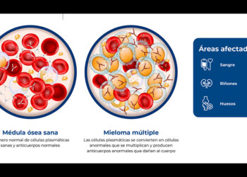 Innovación terapéutica y nuevas guías clínicas transforman el horizonte de supervivencia del Mieloma Múltiple en México