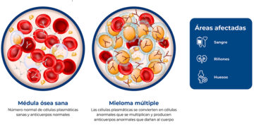 Innovación terapéutica y nuevas guías clínicas transforman el horizonte de supervivencia del Mieloma Múltiple en México